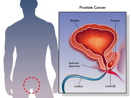 Low Dose Rate Brachytherapy for Prostate Cancer by OrangeCountySurgeons.org - 2